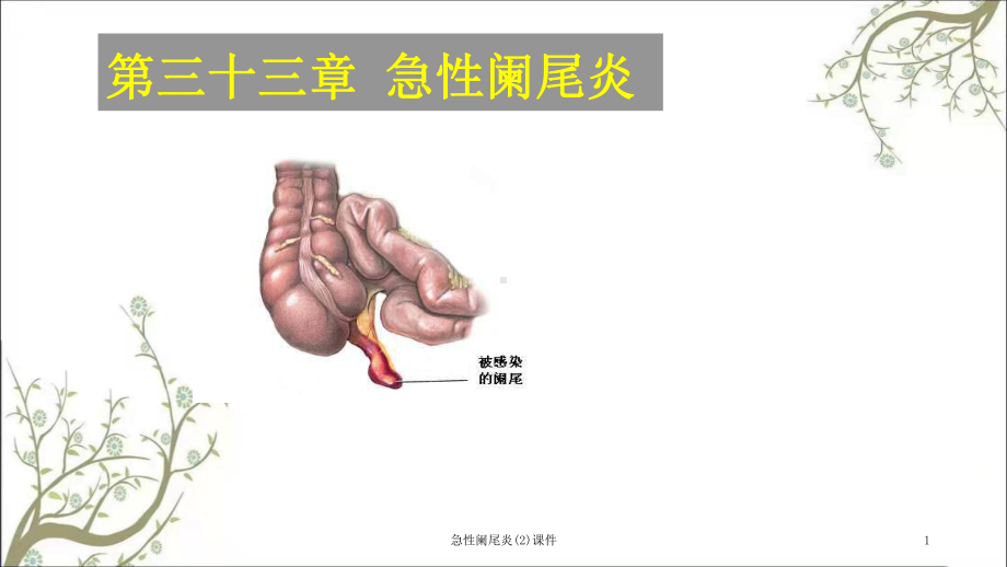 急性阑尾炎课件2.ppt_第1页