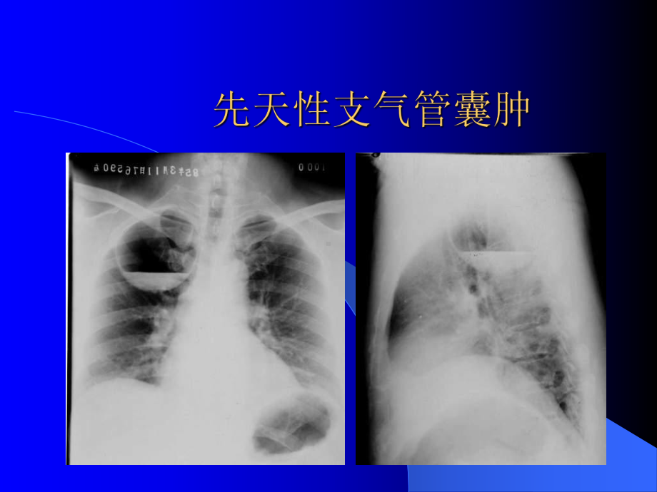 支气管疾病NXPowerLite课件.pptx_第2页