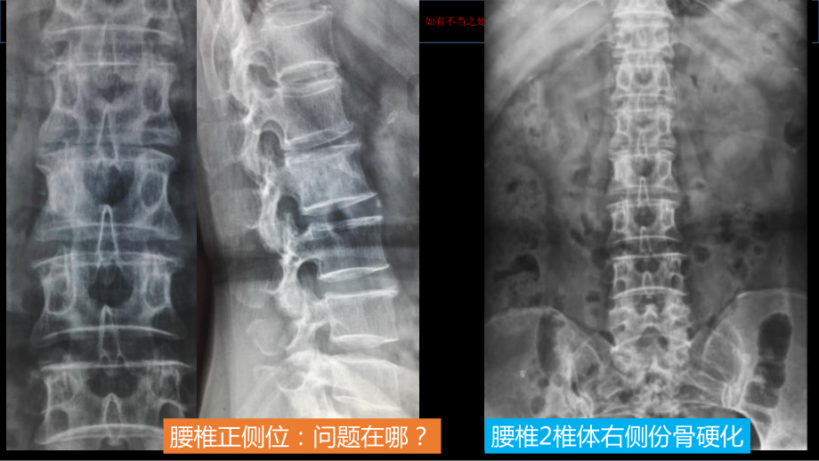 椎体的局灶病变影像表现分析暨影像诊断扩展培训课件.ppt_第3页