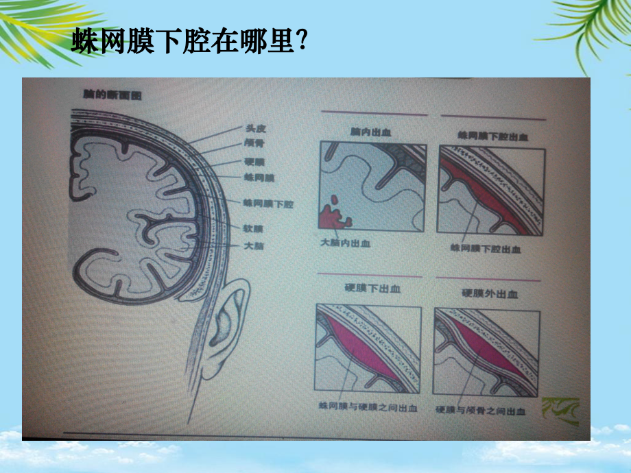 教培用蛛网膜下腔出血的诊治课件.ppt_第2页