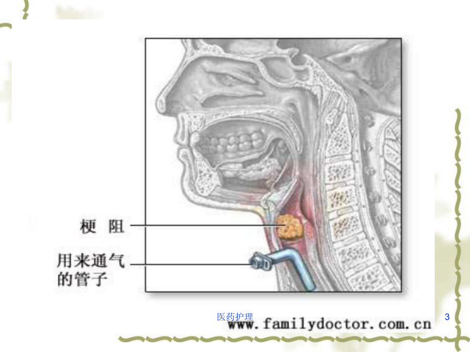 急性喉梗阻的护理(医疗知识)课件.ppt_第3页