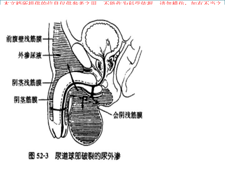 尿道球部破裂培训课件.ppt_第3页