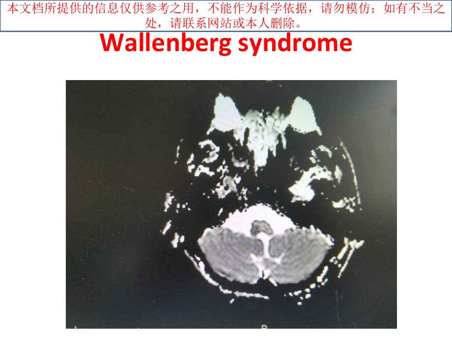 延髓背外侧综合征培训课件.ppt_第3页