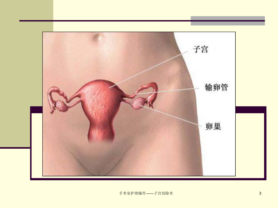 手术室护理操作-子宫切除术课件.ppt_第3页