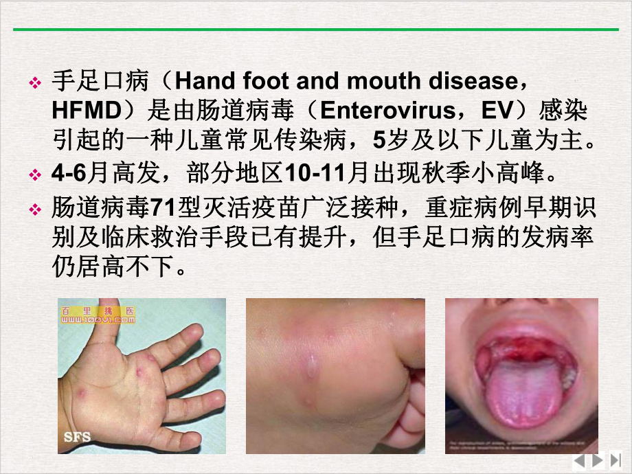 手足口病诊疗指南版课件.ppt_第2页