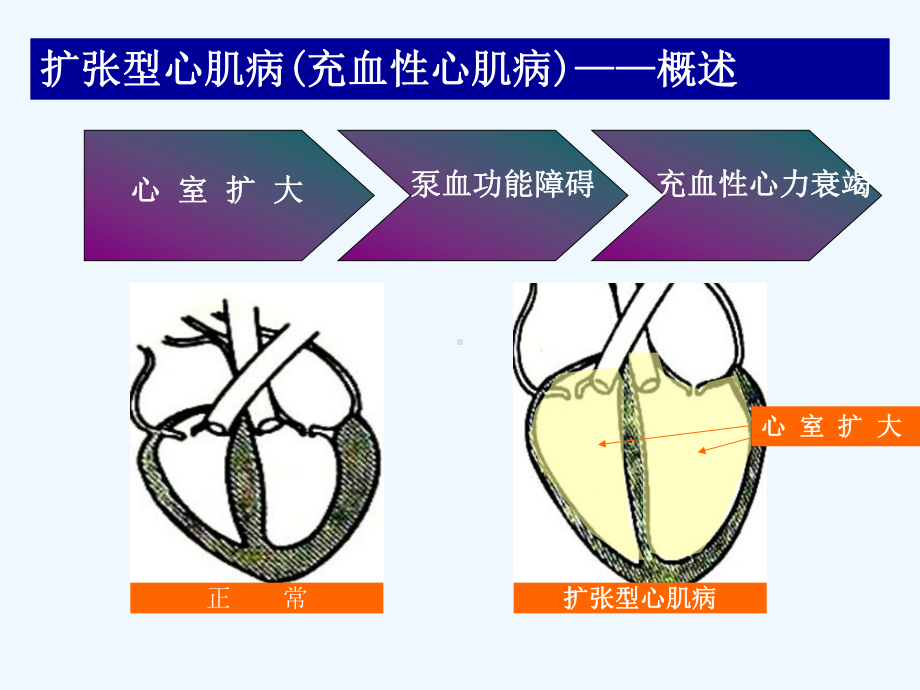 扩张型心肌病查房课件.ppt_第3页