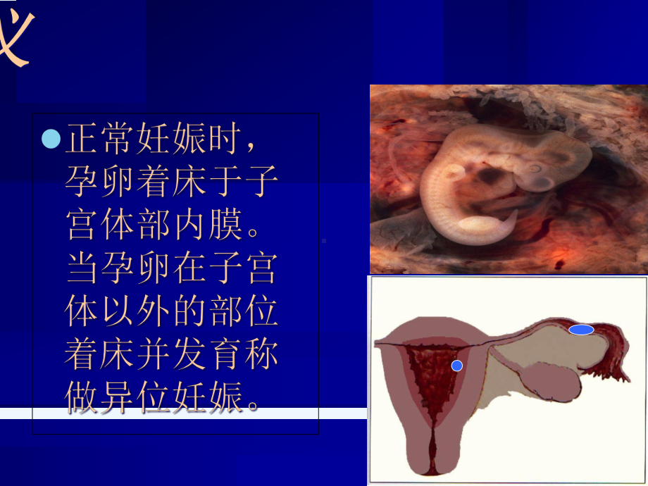 异位妊娠(课件).ppt_第2页