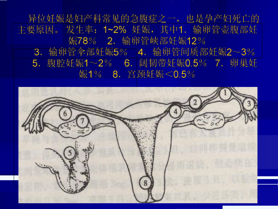 异位妊娠(课件).ppt_第3页