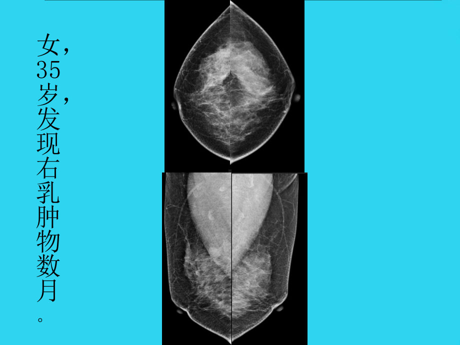 教学培训-乳腺癌的x线诊断及鉴别诊断-课件.ppt_第2页