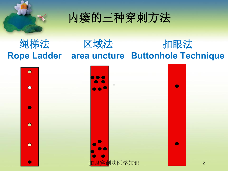 扣眼穿刺法医学知识培训课件.ppt_第2页