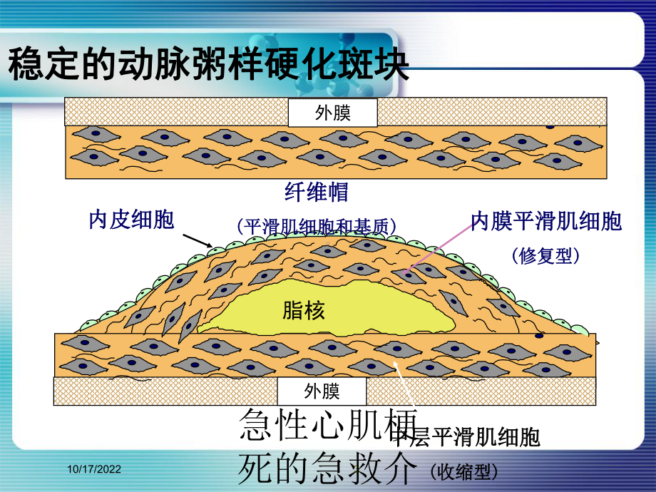 急性心肌梗死的急救介入护理培训课件.ppt_第3页