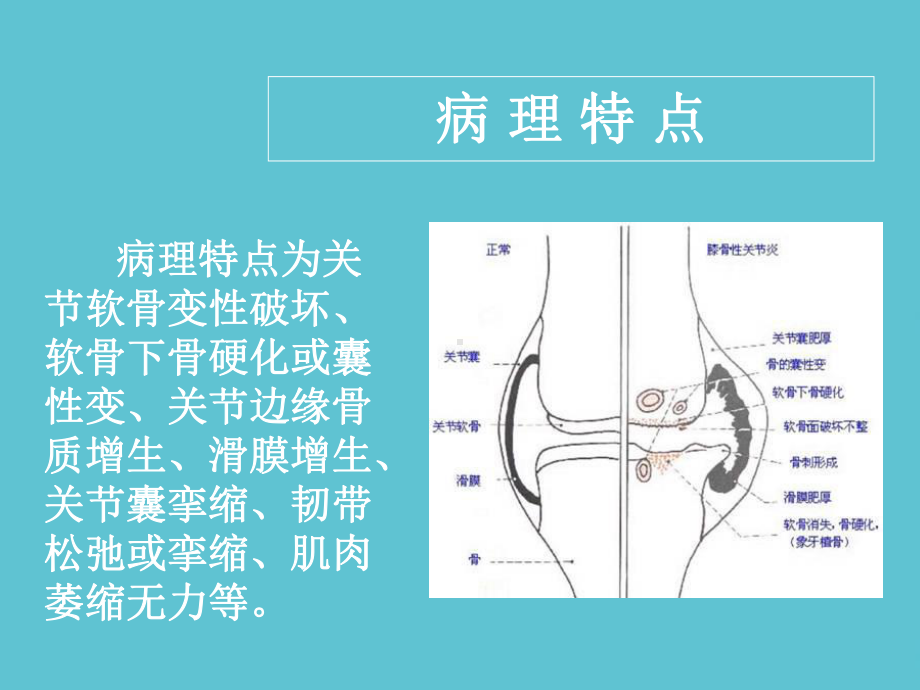 授课用-骨关节炎的康复治疗课件.ppt_第3页