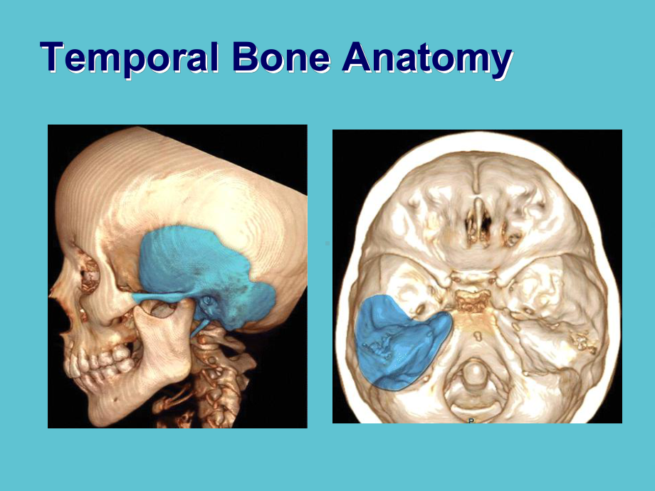 授课用-颞骨骨折课件.ppt_第3页