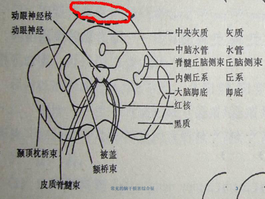 常见的脑干损害综合征培训课件.ppt_第3页