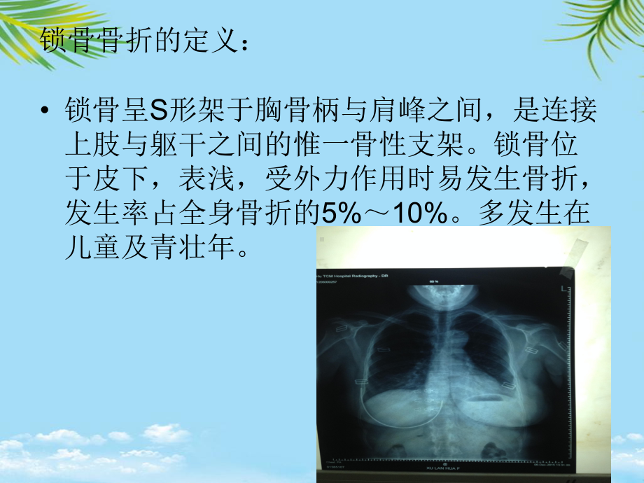 教培用锁骨骨折护理查房课件.pptx_第2页