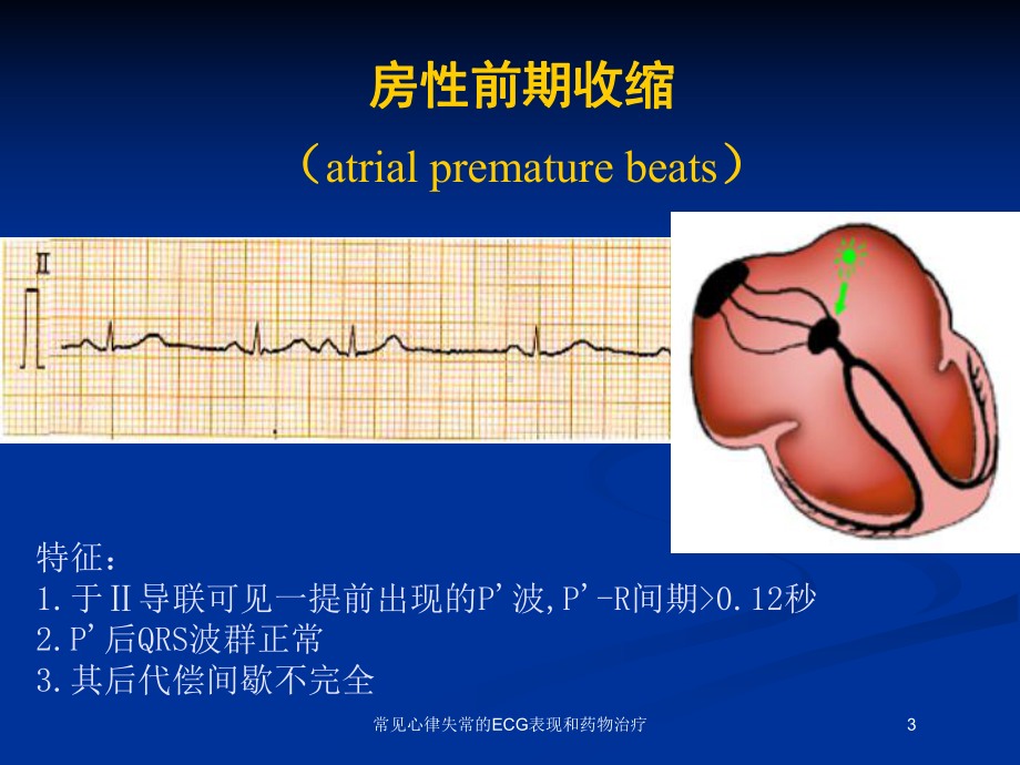 常见心律失常的ECG表现和药物治疗培训课件.ppt_第3页