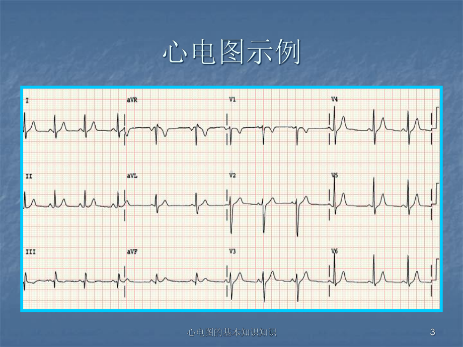 心电图的基本知识知识培训课件.ppt_第3页