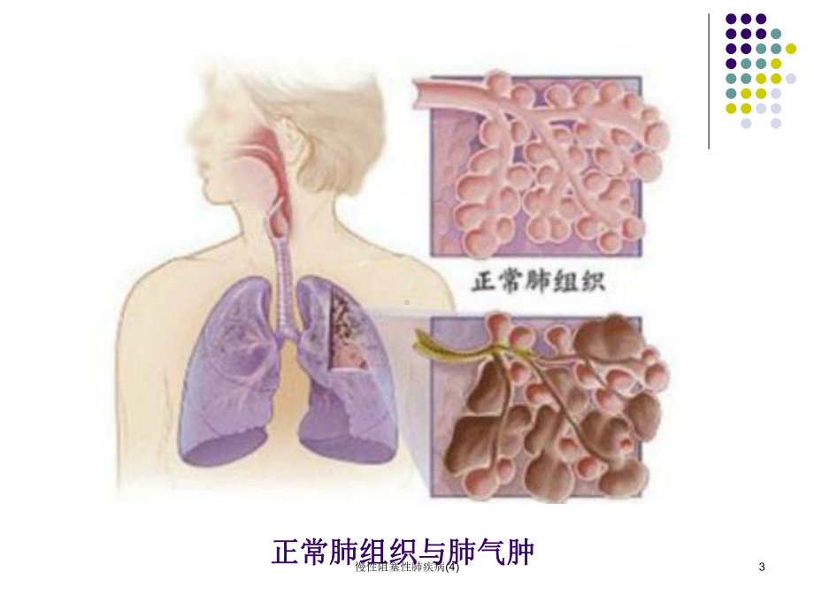 慢性阻塞性肺疾病课件4.ppt_第3页