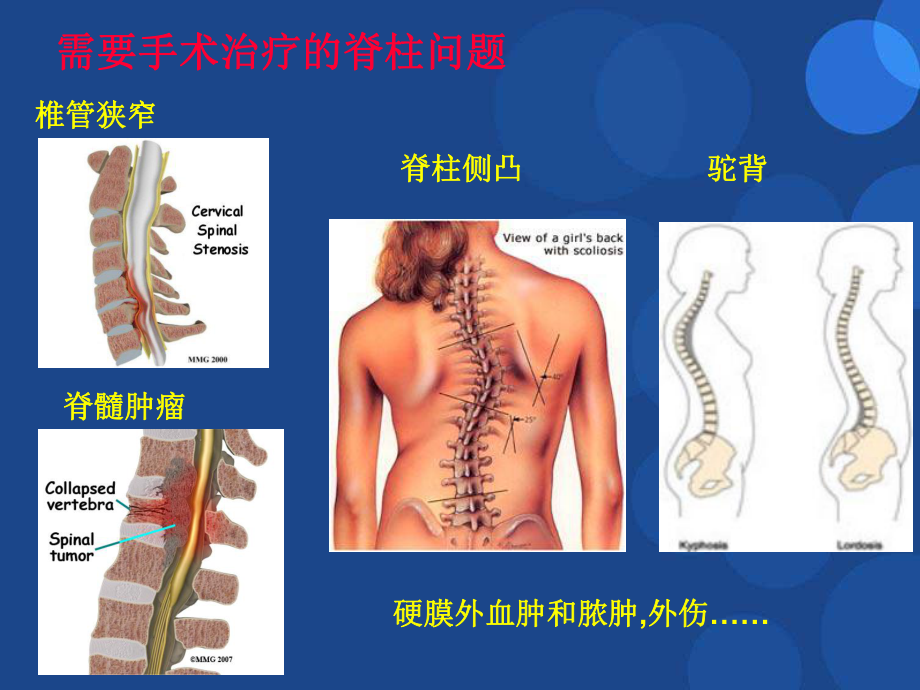 手术室护理查房脊柱手术的麻醉参考课件.ppt_第3页