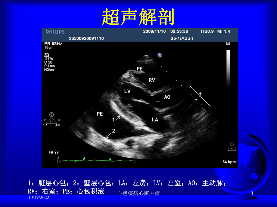 心包疾病心脏肿瘤培训课件.ppt_第3页