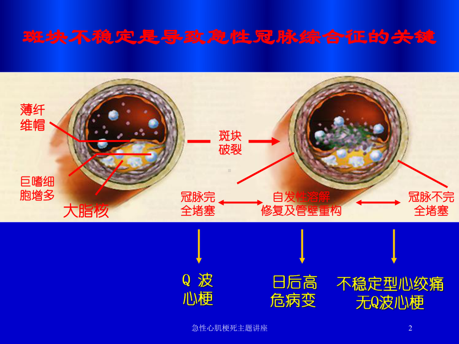 急性心肌梗死主题讲座培训课件.ppt_第2页