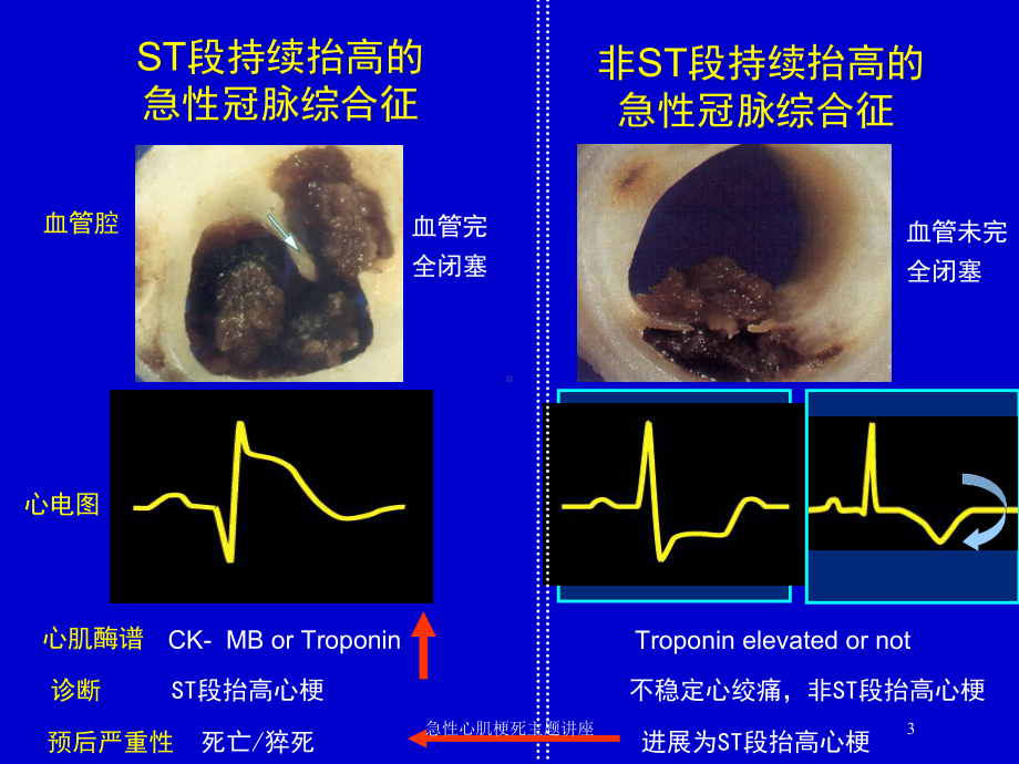 急性心肌梗死主题讲座培训课件.ppt_第3页