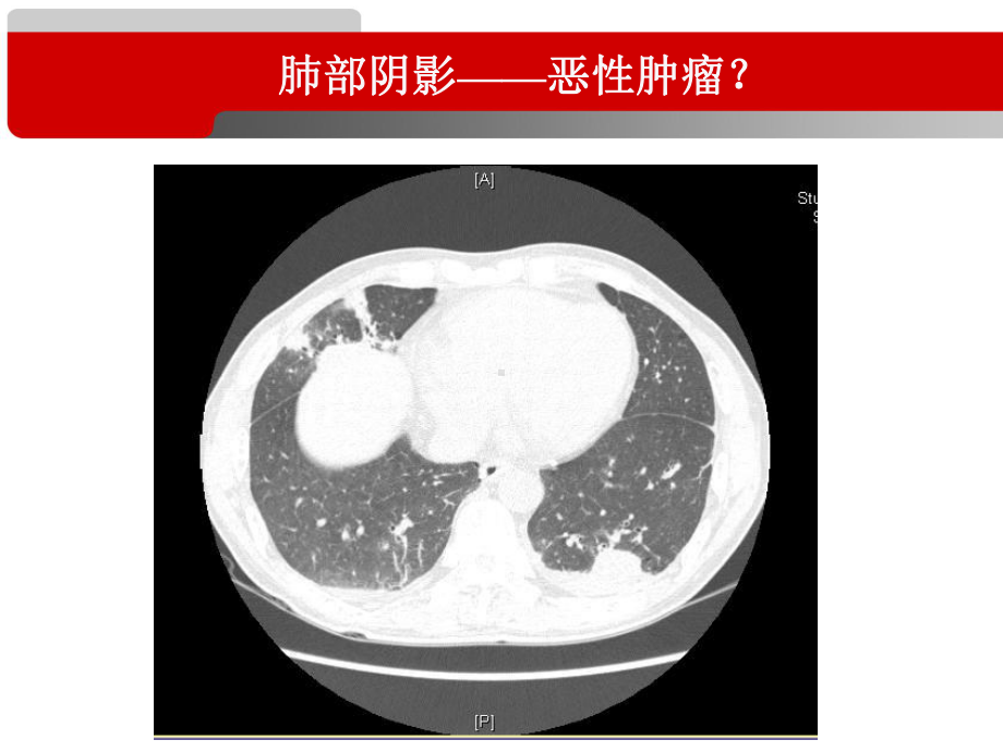 恶性肿瘤合并肺栓塞临床实践课件.ppt_第3页