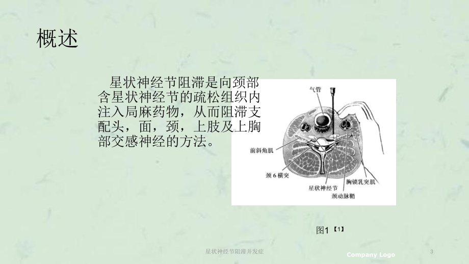 星状神经节阻滞并发症课件.ppt_第3页