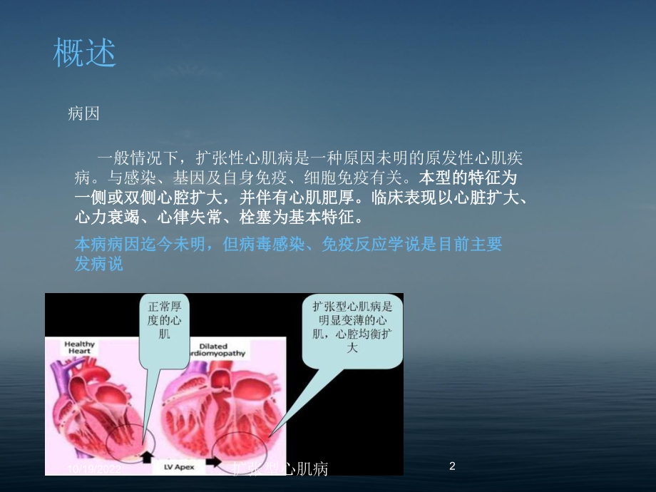 扩张型心肌病培训课件.ppt_第2页