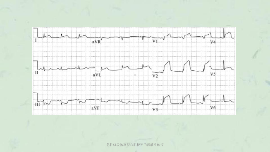 急性ST段抬高型心肌梗死的再灌注治疗课件.ppt_第3页