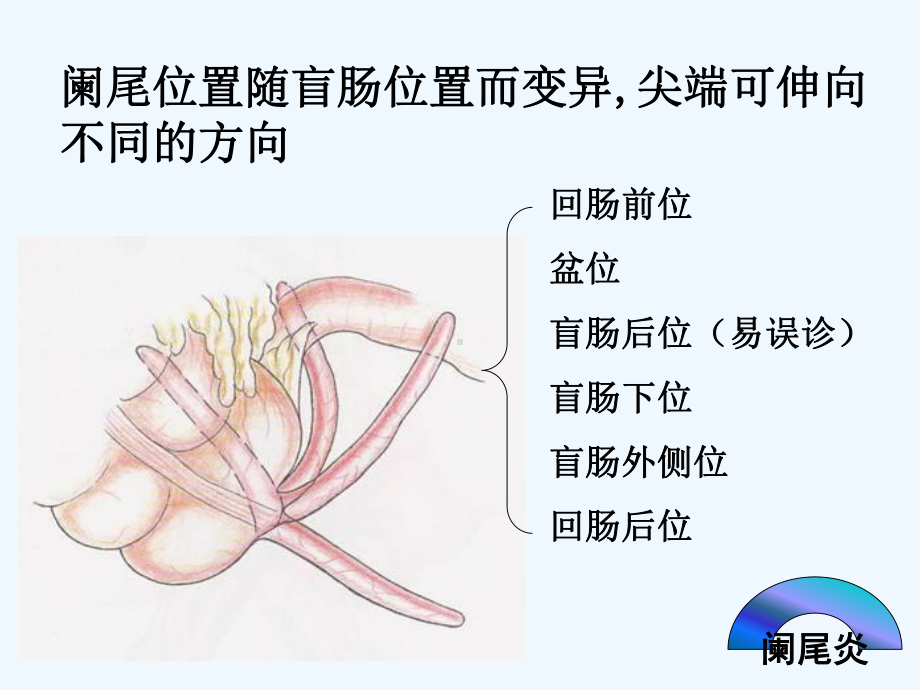 急性阑尾炎患者护理课件.ppt_第3页