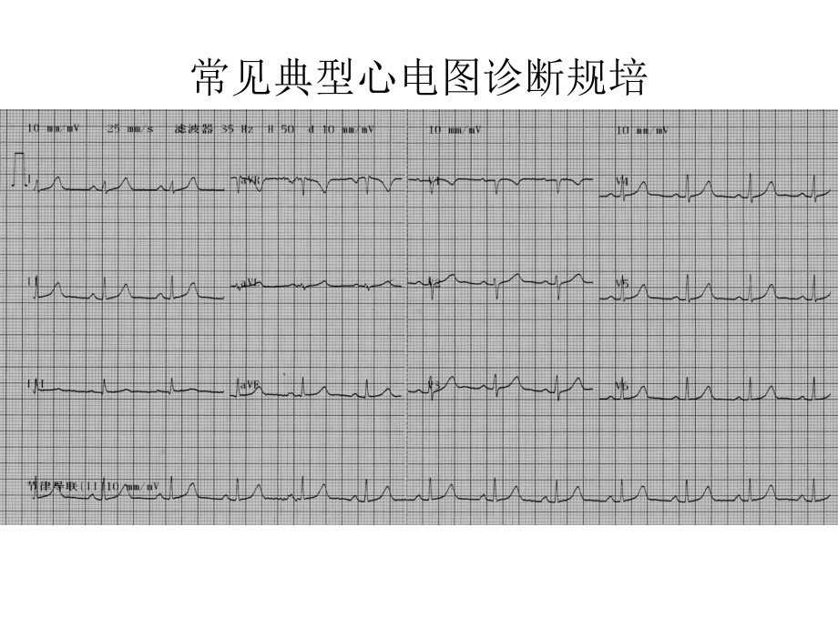 常见典型心电图诊断规培-课件.ppt_第2页