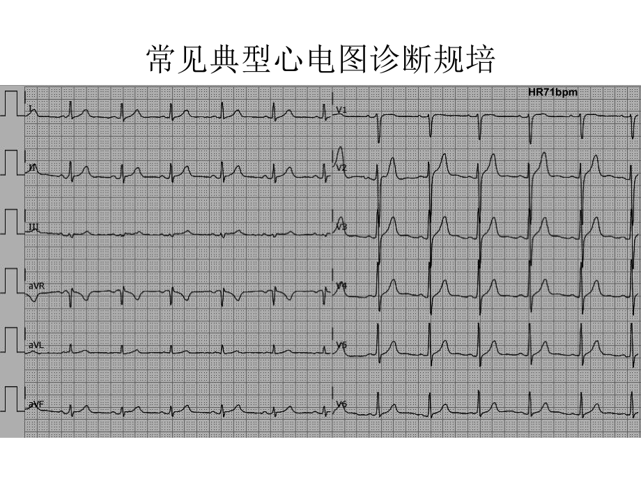 常见典型心电图诊断规培-课件.ppt_第3页