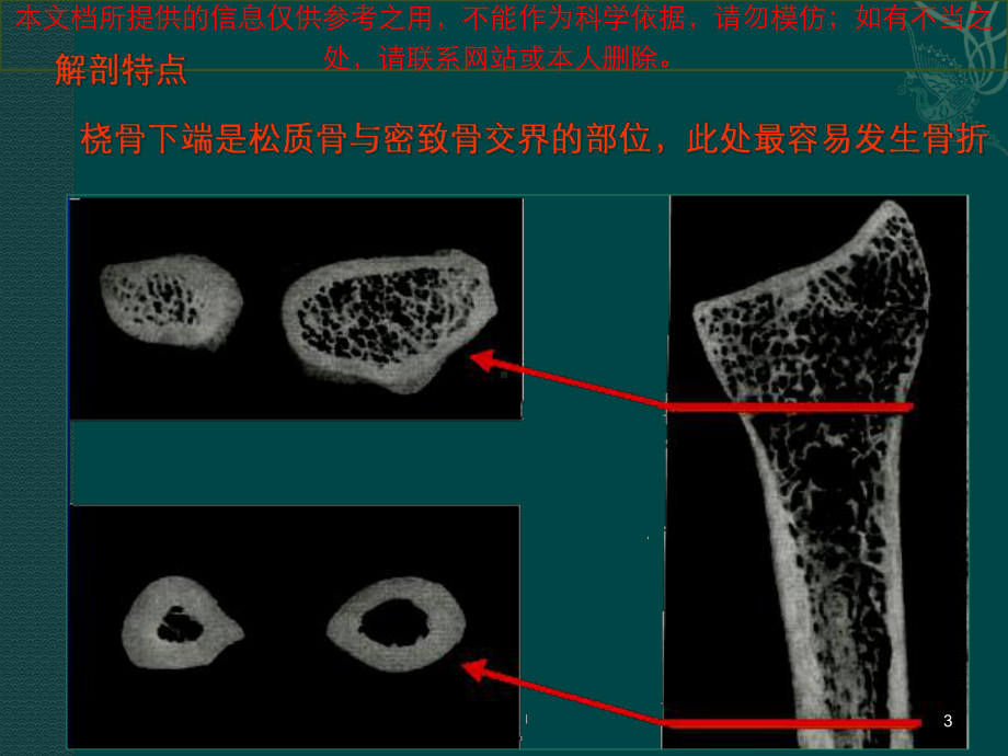 桡骨远端骨折汇总培训课件.ppt_第3页