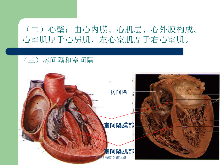 心脏粘液瘤专题宣讲培训课件.ppt_第3页