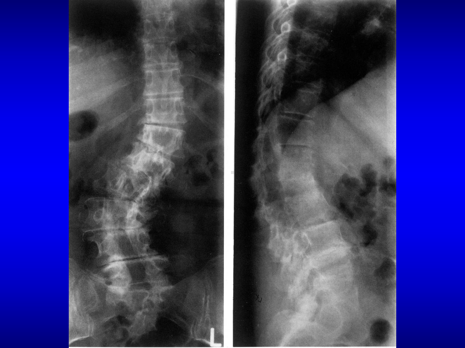 成人脊柱侧凸课件.pptx_第3页