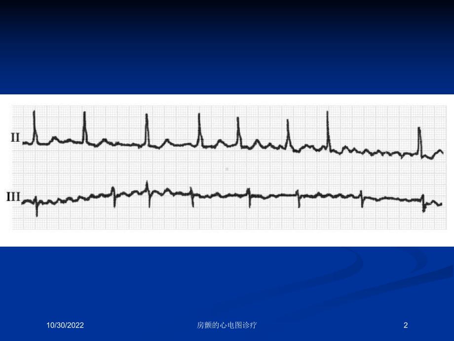 房颤的心电图诊疗培训课件.ppt_第2页