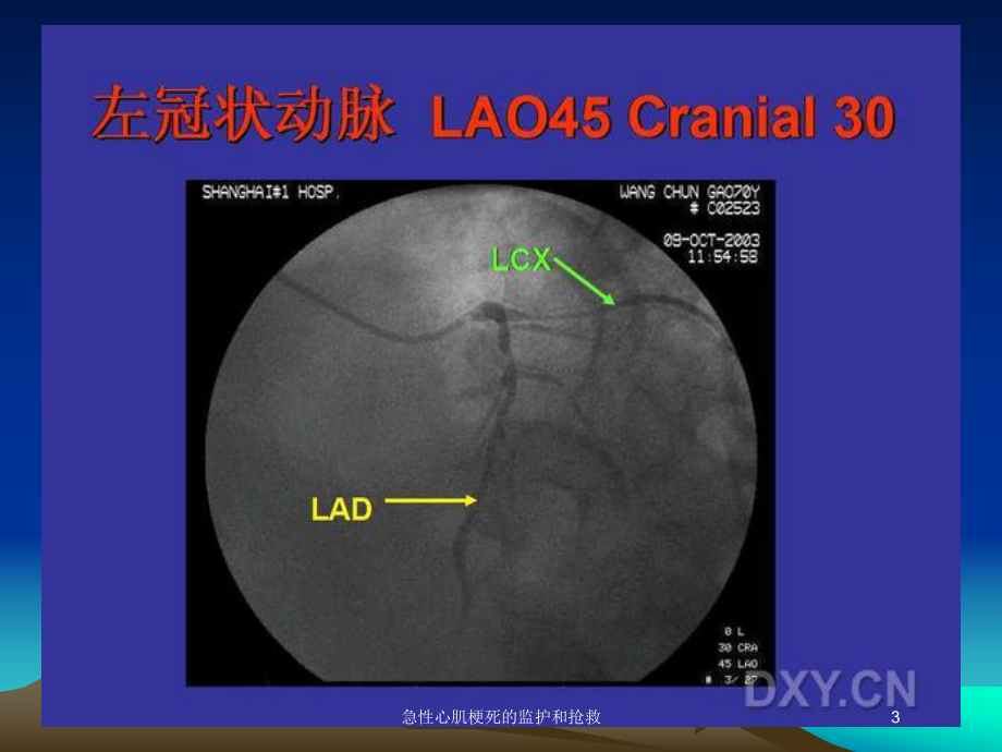 急性心肌梗死的监护和抢救培训课件.ppt_第3页