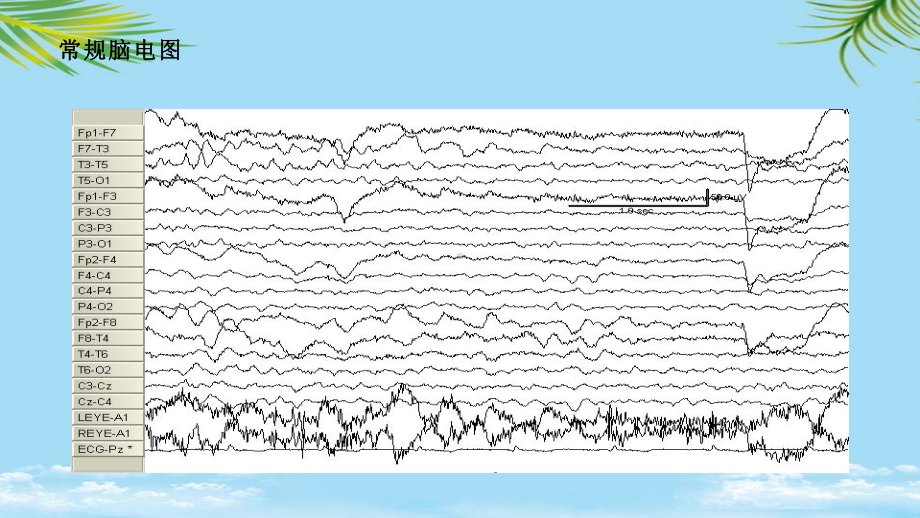 振幅整合脑电图在临床的应用全面课件.pptx_第2页