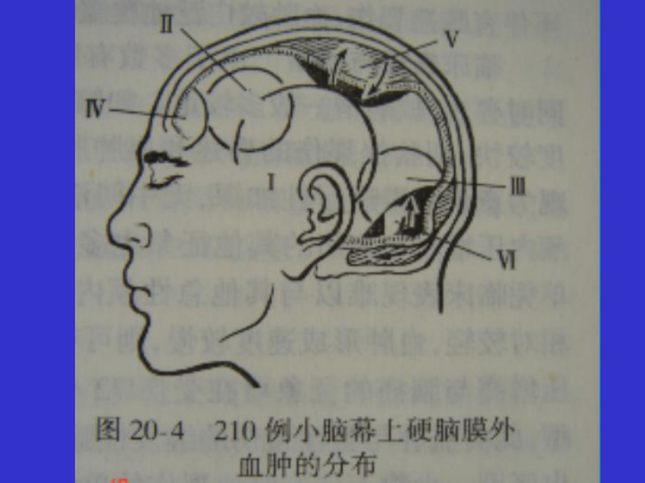 急性硬膜外血肿课件.pptx_第3页