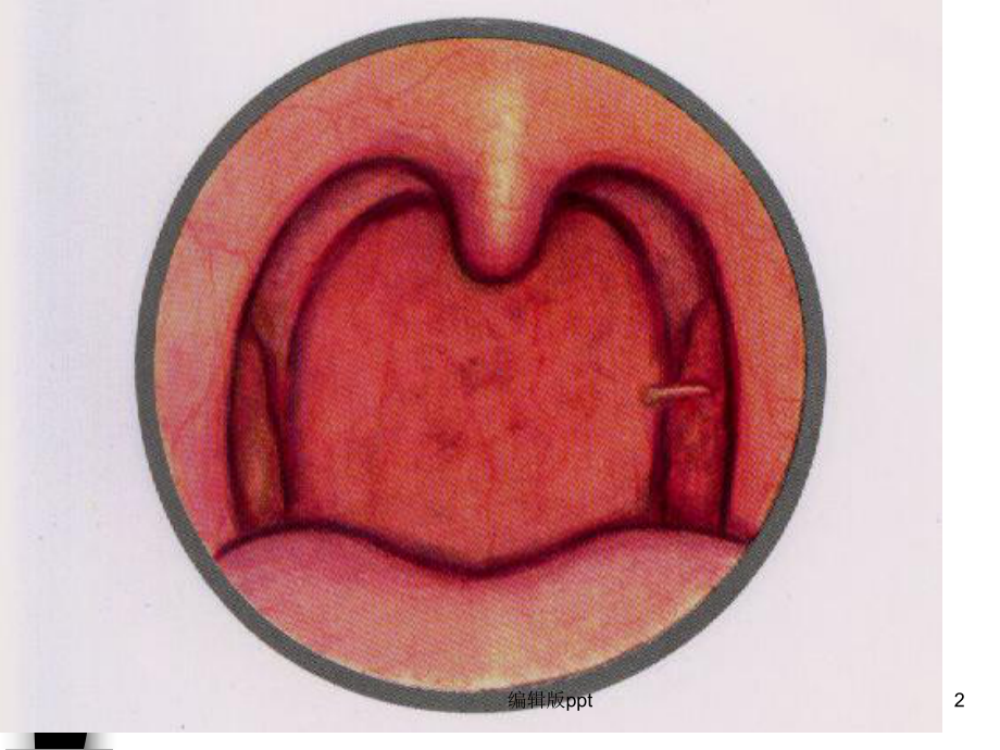 扁桃体炎鼻咽癌病人护理课件.ppt_第2页