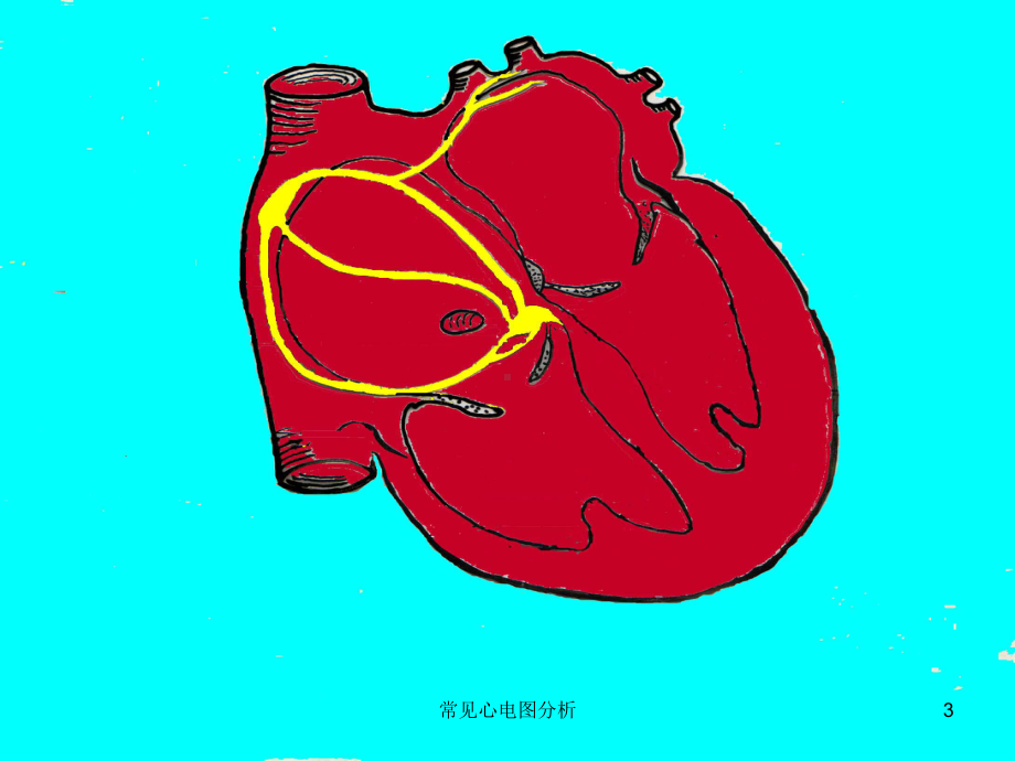 常见心电图分析培训课件.ppt_第3页