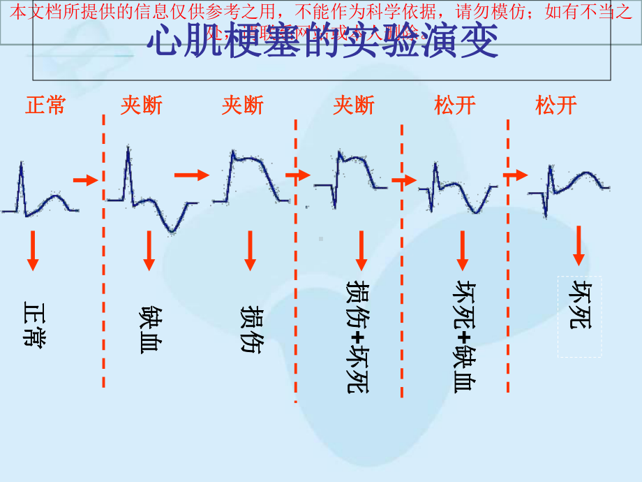 心肌梗死的心电图改变培训课件.ppt_第2页