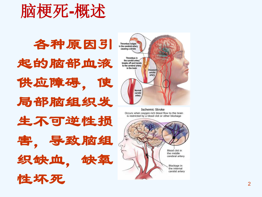 最经典的脑梗死临床表现与治疗课件.ppt_第2页