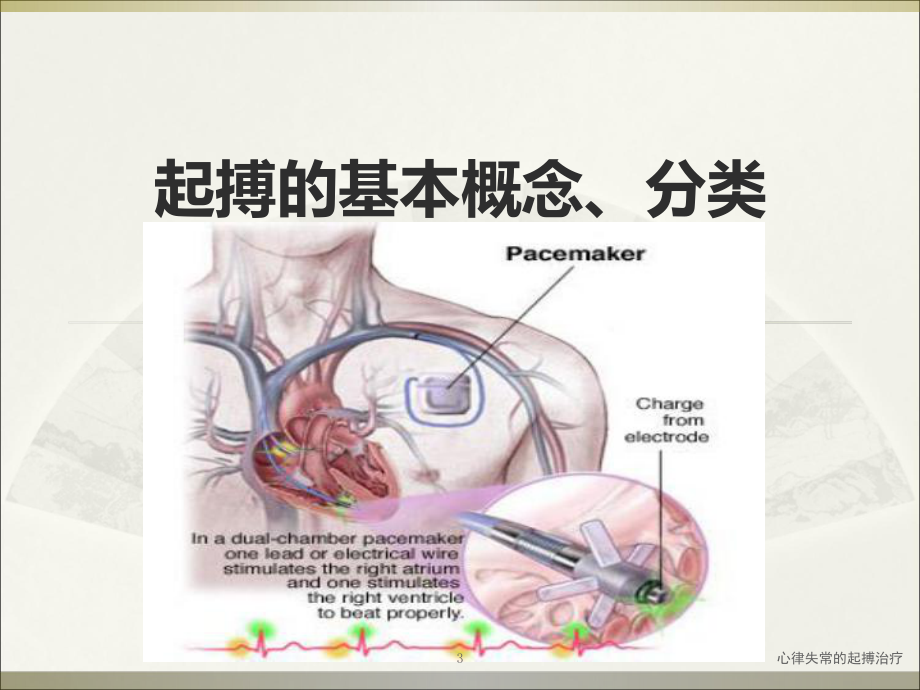 心律失常的起搏治疗课件.ppt_第3页