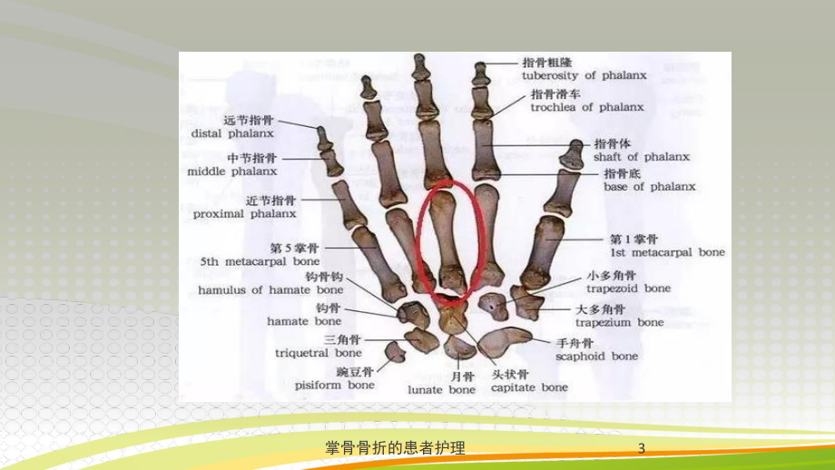 掌骨骨折的患者护理培训课件.ppt_第3页