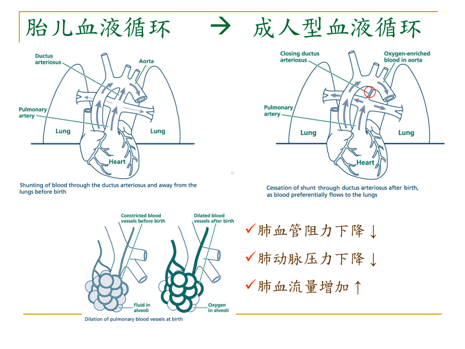 新生儿肺动脉高压培训课件-2.ppt_第3页