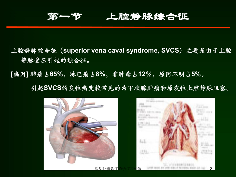 常见肿瘤急症的诊疗和处置培训课件.ppt_第2页