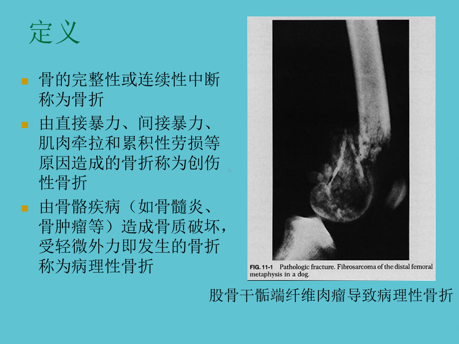 授课用-骨折后康复课件.ppt_第2页