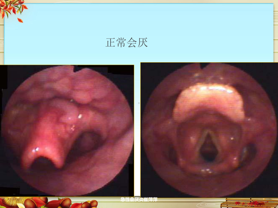 急性会厌炎课件.ppt_第3页